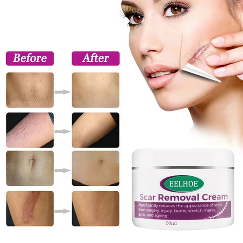 Scar  Removal Cream