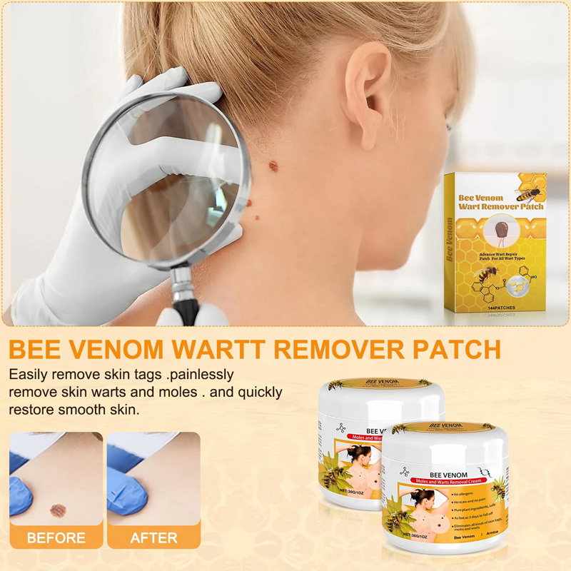 Warts Removal Cream